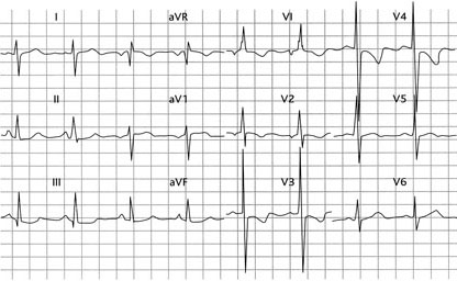 Elektrokardiogram