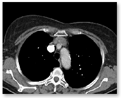 CT-3